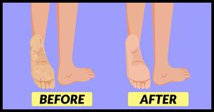 Cure Your Cracked Feet In Time For Summer With These 6 At Home Remedies Cure Your Cracked Feet In Time For Summer With These 6 At Home Remedies