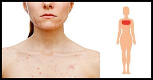 The Hidden Health Issues Related To Body Acne The Hidden Health Issues Related To Body Acne