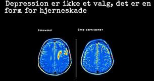 Ny research viser at depression skaber hjerne skade, ikke den anden vej rundt
Ny research viser at depression skaber hjerne skade, ikke den anden vej rundt
