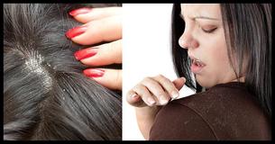 7 Natural Cures That Will Get Rid Of Your Dandruff 7 Natural Cures That Will Get Rid Of Your Dandruff
