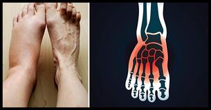 Pieds gonflés: 8 conditions médicales effrayantes qui peuvent faire gonfler tes pieds. Pieds gonflés: 8 conditions médicales effrayantes qui peuvent faire gonfler tes pieds.