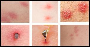 10 Bug Bites Everyone Should Be Able To Identify 10 Bug Bites Everyone Should Be Able To Identify