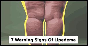 Lipedema Is Often Mistaken For Obesity: 7 Symptoms You Need To Be Aware Of Lipedema Is Often Mistaken For Obesity: 7 Symptoms You Need To Be Aware Of