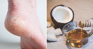 5 Home Remedies For Dreaded Cracked Heels 5 Home Remedies For Dreaded Cracked Heels