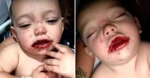 Mom Warning Other Parents To 'Be Careful' After Discovering Red Blisters Inside Her 1-Year-Old’s Mouth Mom Warning Other Parents To 'Be Careful' After Discovering Red Blisters Inside Her 1-Year-Old’s Mouth