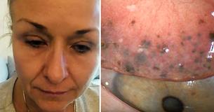 Mujer usa rímel al ir a dormir durante 25 años, y ahora padece de complicaciones en los ojos. Mujer usa rímel al ir a dormir durante 25 años, y ahora padece de complicaciones en los ojos.