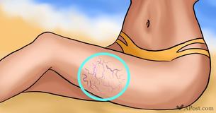 8 Natural Ways To Combat varicose Veins 8 Natural Ways To Combat varicose Veins