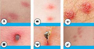 10 Common Bug Bites You Should Know How To Identify 10 Common Bug Bites You Should Know How To Identify