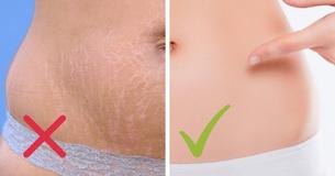 8 Natural Tips That Fade Your Stretch Marks 8 Natural Tips That Fade Your Stretch Marks