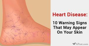 Heart Disease: 10 Warning Signs That Might Appear On Your Skin Heart Disease: 10 Warning Signs That Might Appear On Your Skin