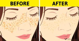 7 Old-Fashioned Tips That Will Make Acne Scars And Skin Imperfections A Thing Of The Past 7 Old-Fashioned Tips That Will Make Acne Scars And Skin Imperfections A Thing Of The Past