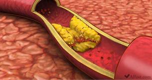 Updated Cholesterol Guidelines To Promote Heart Health: What You Must Know Updated Cholesterol Guidelines To Promote Heart Health: What You Must Know