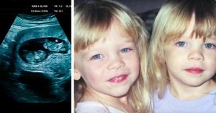 Unos padres encuentran a una de sus gemelas colapsada en el baño del piso, después el doctor encuentra una 'bola' en su cerebro Unos padres encuentran a una de sus gemelas colapsada en el baño del piso, después el doctor encuentra una 'bola' en su cerebro