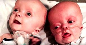 Deformed Twins Get Left Behind At The Hospital Without Parents, So Nurse Takes Them Home Deformed Twins Get Left Behind At The Hospital Without Parents, So Nurse Takes Them Home