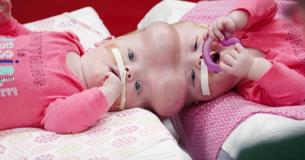 Almost Two Years After Their Separation, Conjoined Twins Celebrate Their New Lives Almost Two Years After Their Separation, Conjoined Twins Celebrate Their New Lives