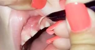 Boy Complains His Gums Hurt So Mom Grabs The Tweezers And Yanks 27 Of Them Out Boy Complains His Gums Hurt So Mom Grabs The Tweezers And Yanks 27 Of Them Out