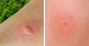 12 Bug Bites Everybody Should Be Able To Recognize And Identify 12 Bug Bites Everybody Should Be Able To Recognize And Identify