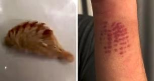 Adolescente aparece com marca de queimadura no braço e a mãe descobre que é de uma lagarta mortal Adolescente aparece com marca de queimadura no braço e a mãe descobre que é de uma lagarta mortal