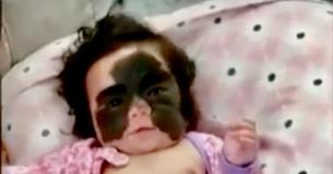 Madre de una niña con marca de nacimiento que parece máscara de Batman habla sobre el bullying que sufre su hija Madre de una niña con marca de nacimiento que parece máscara de Batman habla sobre el bullying que sufre su hija