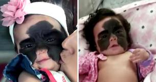 Mom Launches Acceptance Campaign After Strangers Ridicule Daughter With Facial Birthmark Mom Launches Acceptance Campaign After Strangers Ridicule Daughter With Facial Birthmark