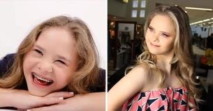 Une jeune fille de 14 ans atteinte du syndrome de la trisomie au Bresil se fait engager par 5 agences de mannequins Une jeune fille de 14 ans atteinte du syndrome de la trisomie au Bresil se fait engager par 5 agences de mannequins