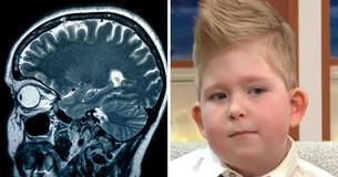 UK Boy Born With 2% Of Brain UK Boy Born With 2% Of Brain