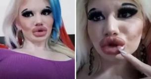 Student Triples Size Of Her Lips In Order To Be More Fashionable Student Triples Size Of Her Lips In Order To Be More Fashionable