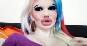 Une femme se fait faire vingt injections pour obtenir le record des plus grosses lèvres Une femme se fait faire vingt injections pour obtenir le record des plus grosses lèvres