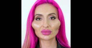 Social Media Model Addicted To Cheek Fillers Has The 'Largest Cheeks On Record' Social Media Model Addicted To Cheek Fillers Has The 'Largest Cheeks On Record'