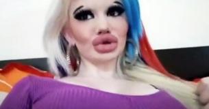 Woman Receives Seventeen Injections In Order To Obtain Largest Lips On The Planet Woman Receives Seventeen Injections In Order To Obtain Largest Lips On The Planet