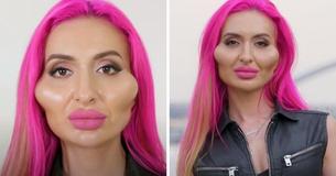 Le mannequin aux « plus grosses joues du monde » montre son apparence avant sa transformation sur une photo Le mannequin aux « plus grosses joues du monde » montre son apparence avant sa transformation sur une photo