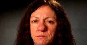 Una cirugía de nariz le cambió la vida a una mujer y transformó totalmente su aspecto Una cirugía de nariz le cambió la vida a una mujer y transformó totalmente su aspecto