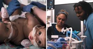 Conjoined Twins Successfully Separated In ‘Rare’ and ‘Groundbreaking’ Surgery Conjoined Twins Successfully Separated In ‘Rare’ and ‘Groundbreaking’ Surgery