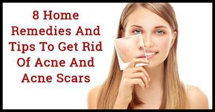 8 Home Remedies And Tips To Get Rid Of Acne And Acne Scars 8 Home Remedies And Tips To Get Rid Of Acne And Acne Scars