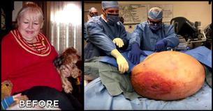 Mom Thinks She’s Gaining Weight With Age Until Doctors Remove 140-Pound Ovarian Cyst Mom Thinks She’s Gaining Weight With Age Until Doctors Remove 140-Pound Ovarian Cyst