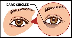 5 Natural Methods To Remove Dark Circles Under Your Eyes 5 Natural Methods To Remove Dark Circles Under Your Eyes