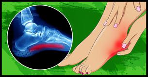 If You Suffer From Foot Pain, You Need To Learn About Plantar Fasciitis If You Suffer From Foot Pain, You Need To Learn About Plantar Fasciitis