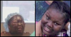 A 12-Year-Old Threw Boiling Water On Her Friend's Face While She Slept At A Sleepover. Why? She Was Annoyed With Her A 12-Year-Old Threw Boiling Water On Her Friend's Face While She Slept At A Sleepover. Why? She Was Annoyed With Her