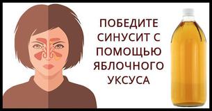 Как за считанные минуты одолеть инфекцию синусовых пазух с помочью яблочного уксуса Как за считанные минуты одолеть инфекцию синусовых пазух с помочью яблочного уксуса