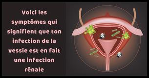 7 symptômes majeurs qui signifient que ton infection vésicale est en fait une infection rénale 7 symptômes majeurs qui signifient que ton infection vésicale est en fait une infection rénale