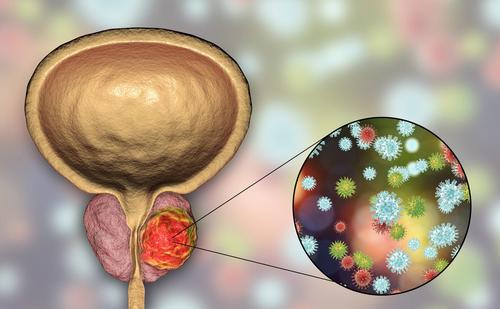 la prostatite può trasformarsi in cancro la prostatite può trasformarsi in cancro